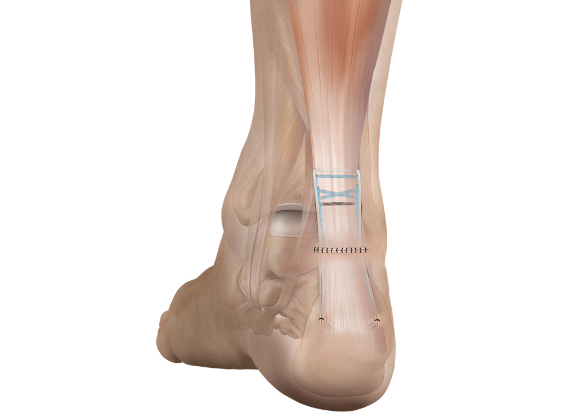 Arthrex - Implant System, Achilles Midsubstance SpeedBridge